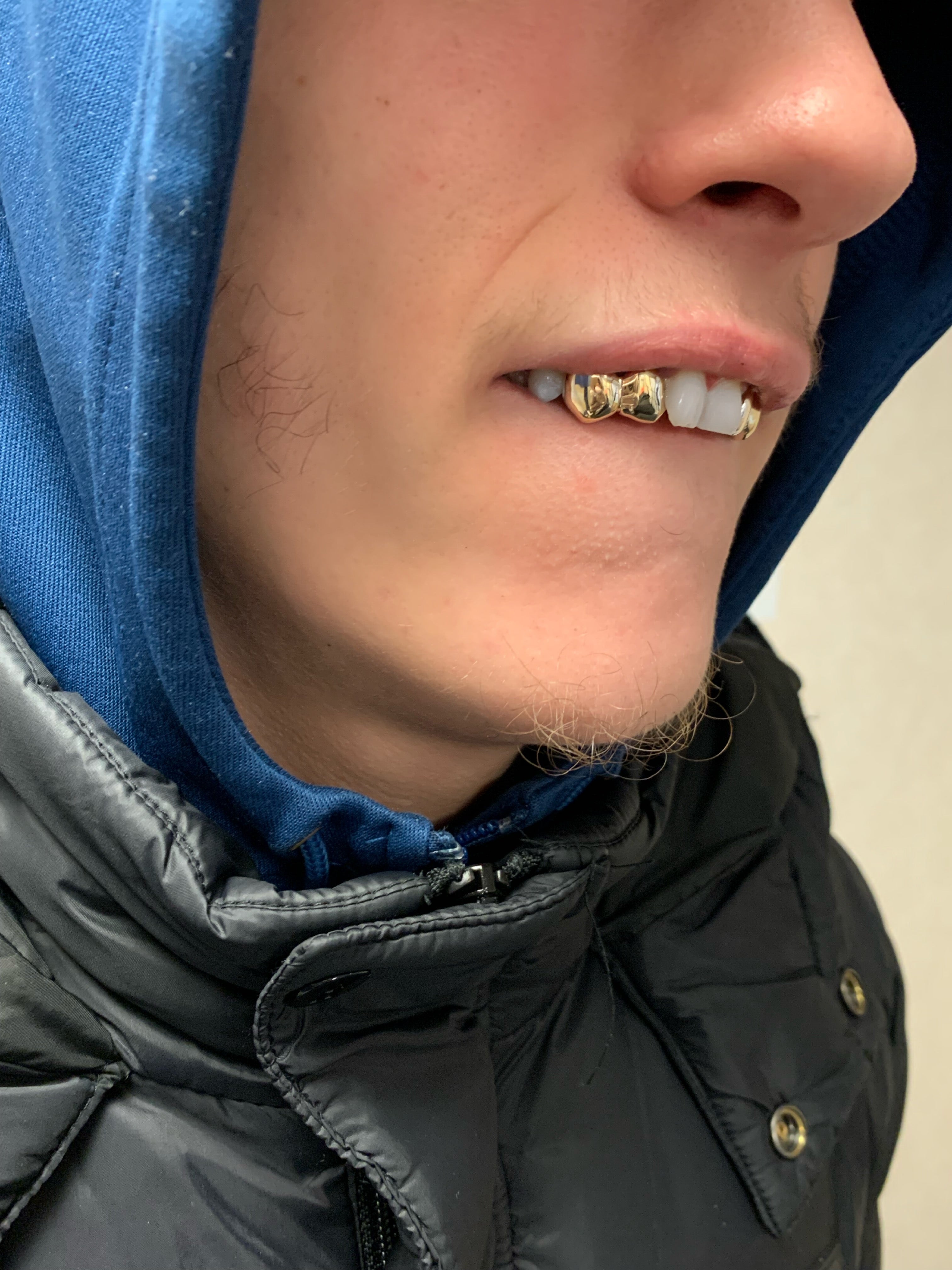 Gold tooth cap discount