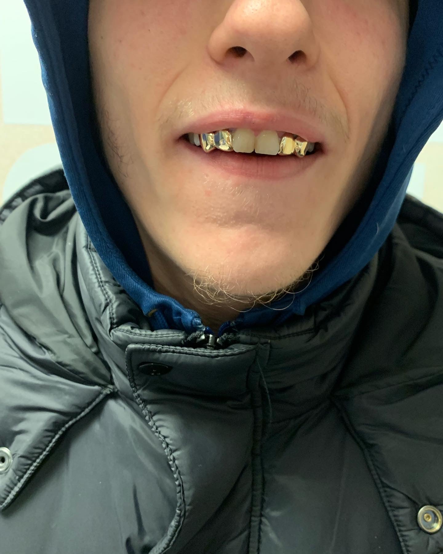 Gold teeth Set (4+ caps) MKGRILLZ LTD